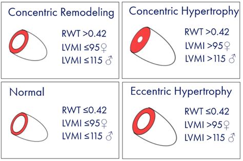 lvmi echo calculator|regional wall thickness calculator echo.